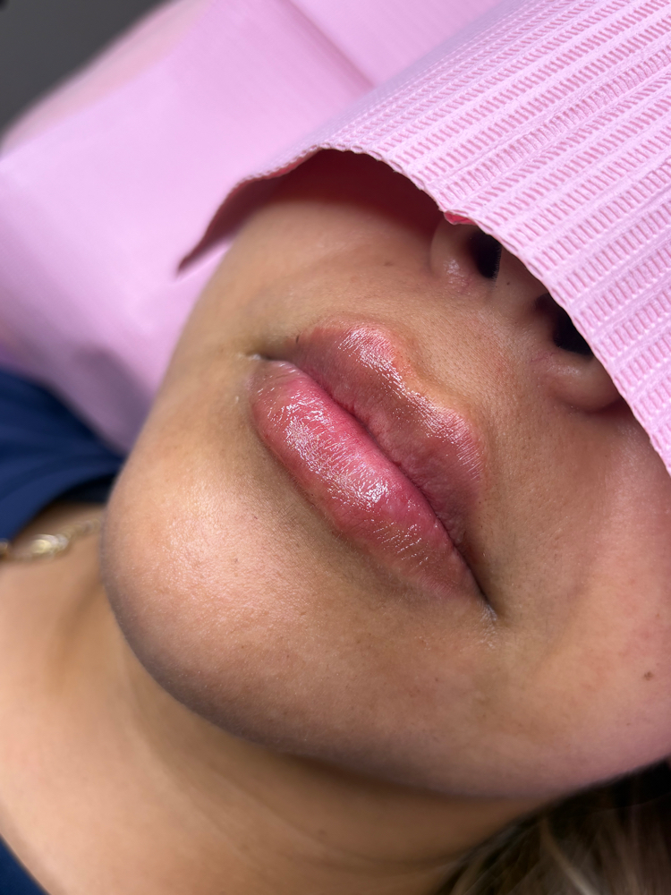 0.5ml (Half Syringe at PuraGlow Aesthetic in Oklahoma City, OK