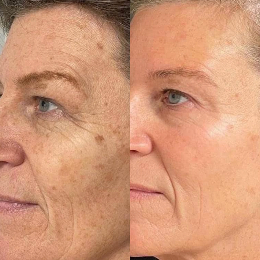 PROCELL Microchanneling at Skin Ritual Esthetics in Clayton, NC