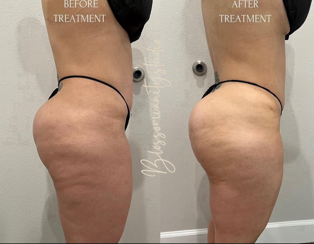 Cellulite + Booty Sculpt Treatment at Blossom Vanity Spa in Missouri City, TX