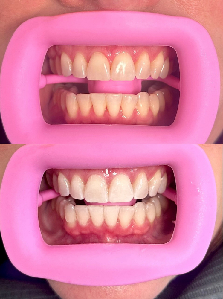 Full Teeth Whitening