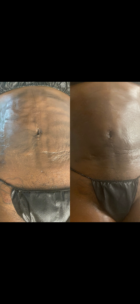 Individual Fibrosis Treatment