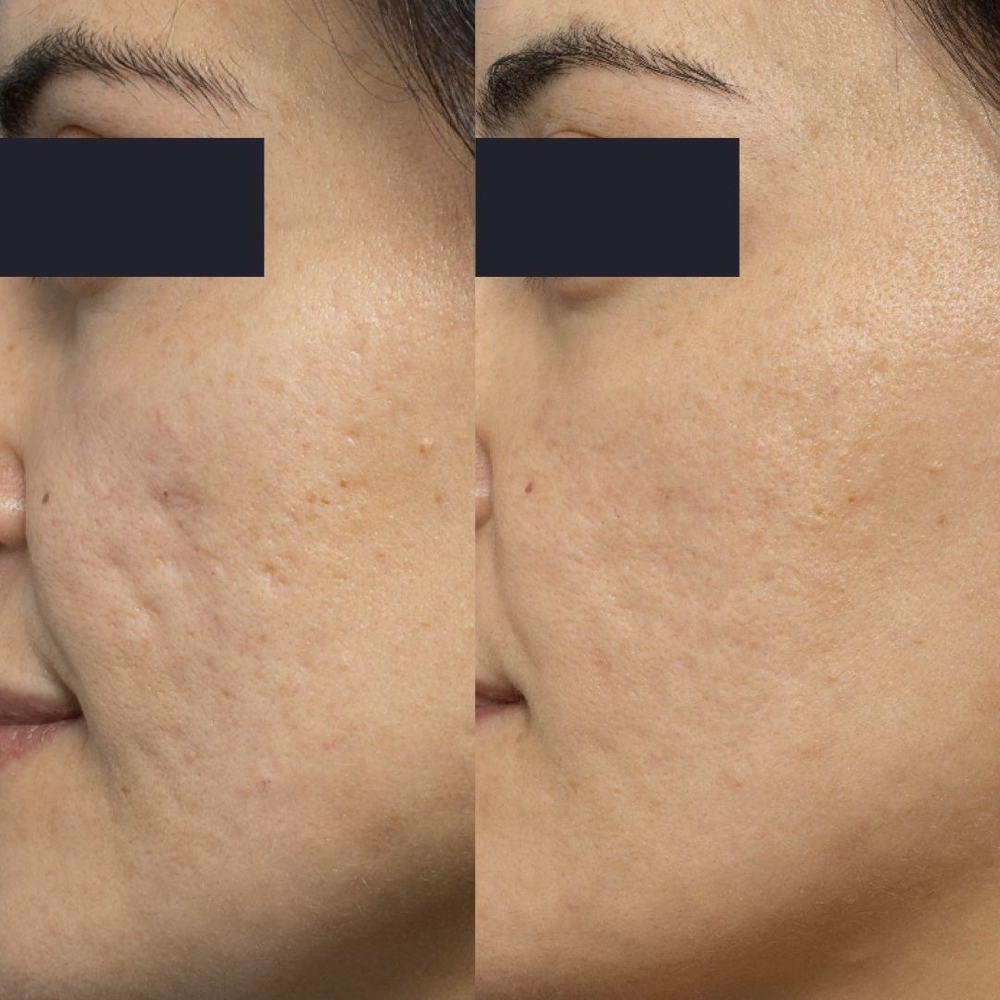 Tratamiento Cicatrices De Acne