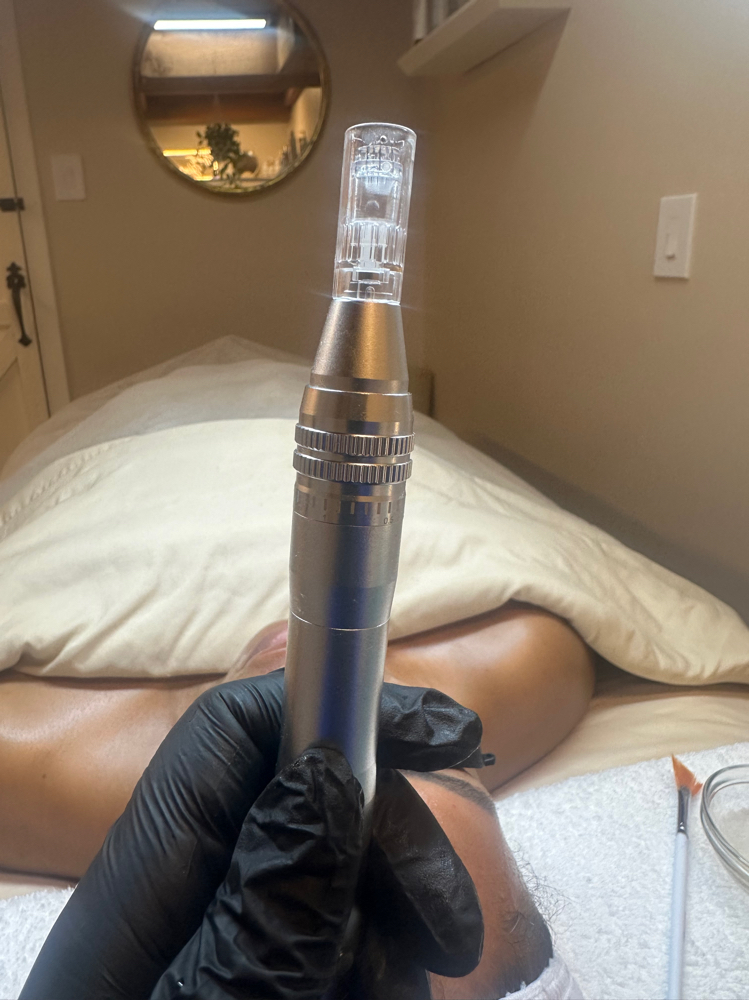 Microneedling Facial at J Esthetics in Homewood, IL