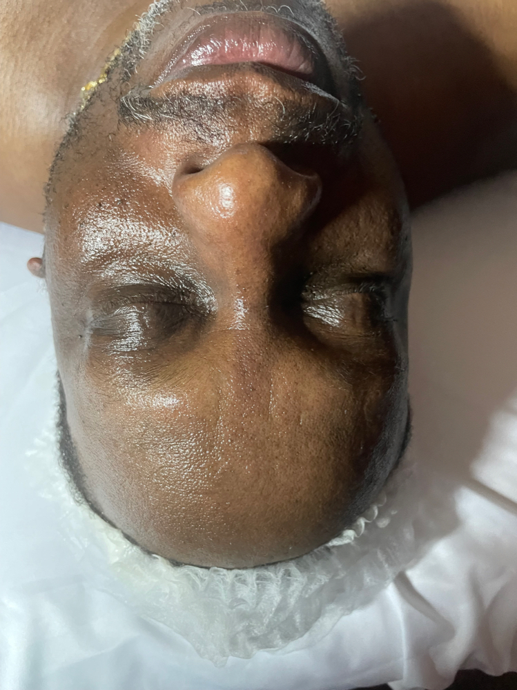 Microdermabraison With Mask