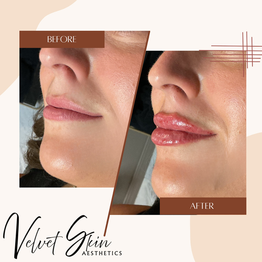 Dermal Filler