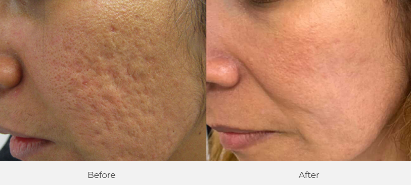 Microneedling