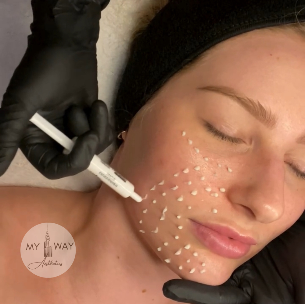 CELLSTORY “Liquid Microneedling”