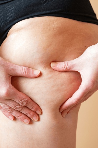 Cellulite Treatments at Skin Therapy LLC in Lincolnton, NC