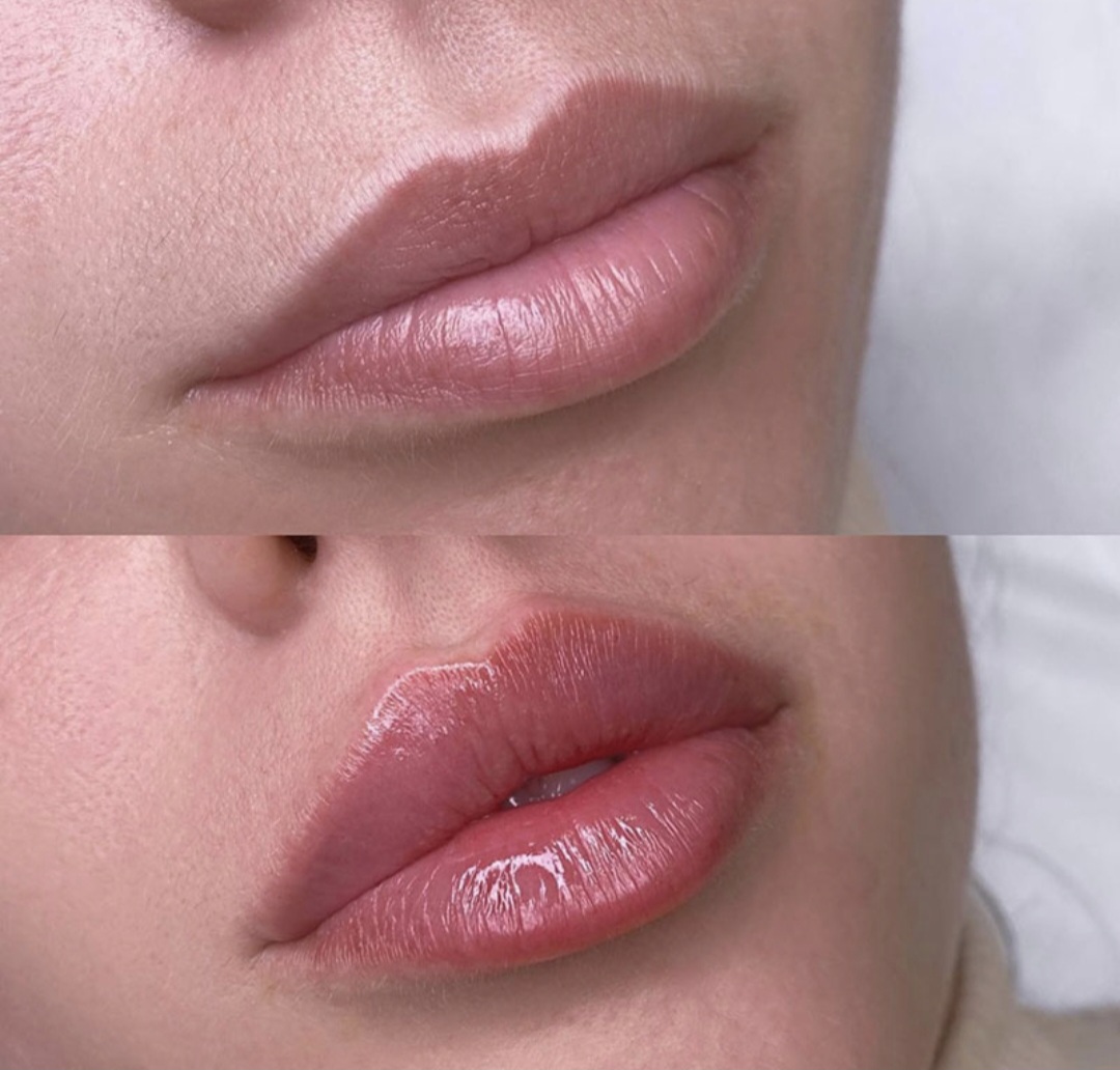 Dermal Lip Filler $475