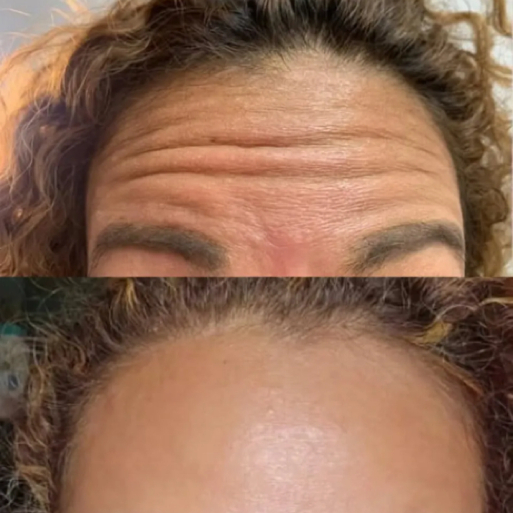 Wrinkle Treatment Upper at Mily Aesthetics in Newark, NJ