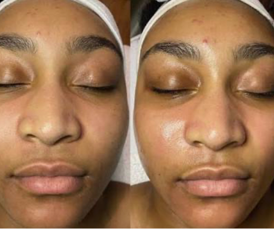 Dermaplanning Glow Facial