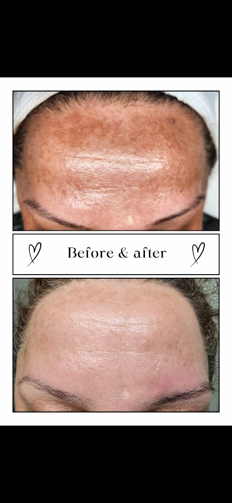 Peel & Skincare at Morning Glow Esthetics in Palm Desert, CA