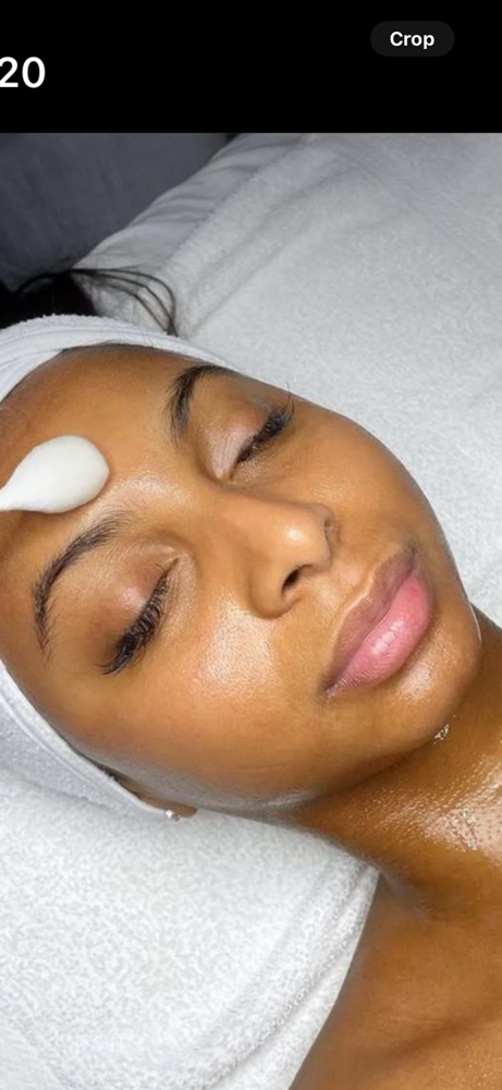 Chemical Peel