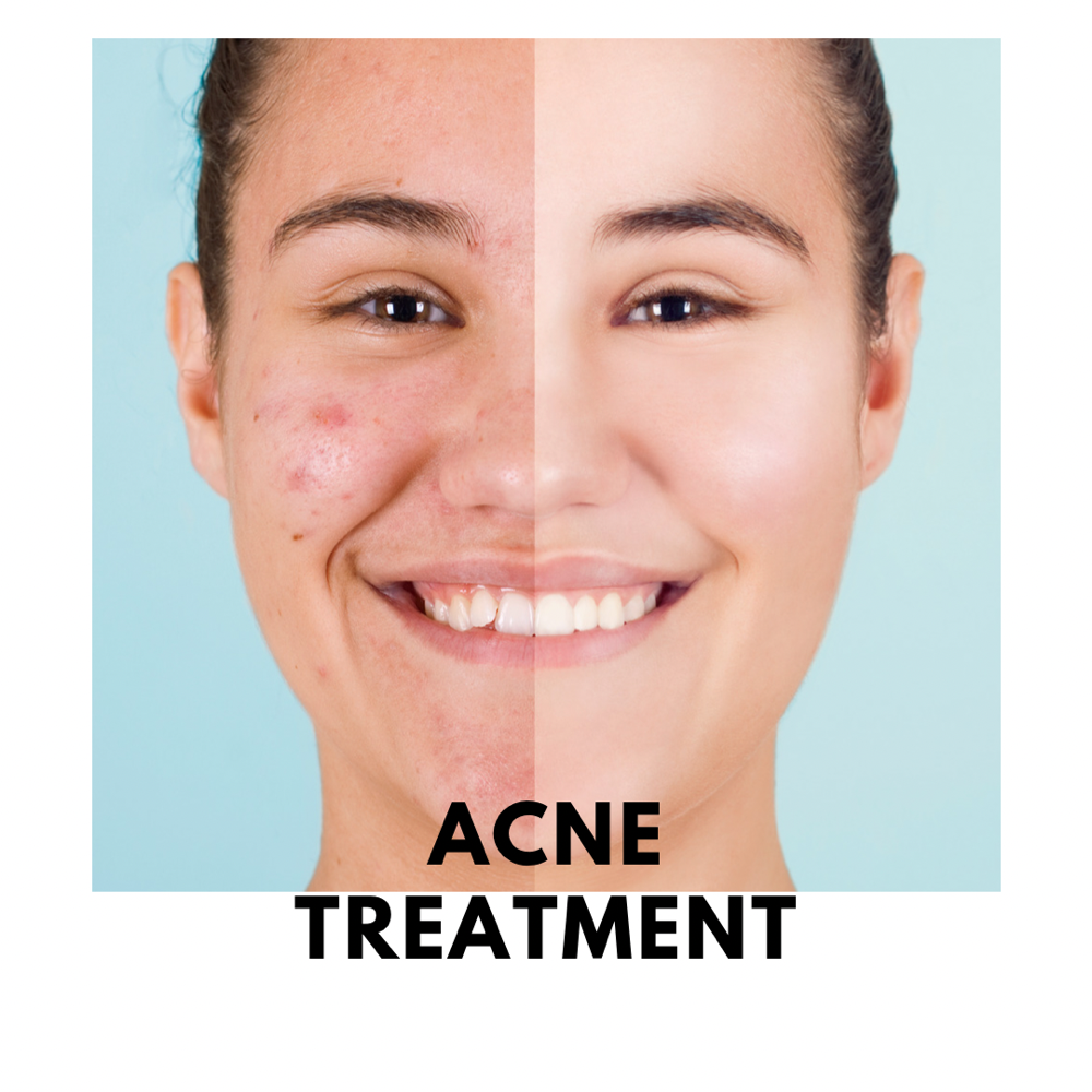 IPL Acne Treatment/consult