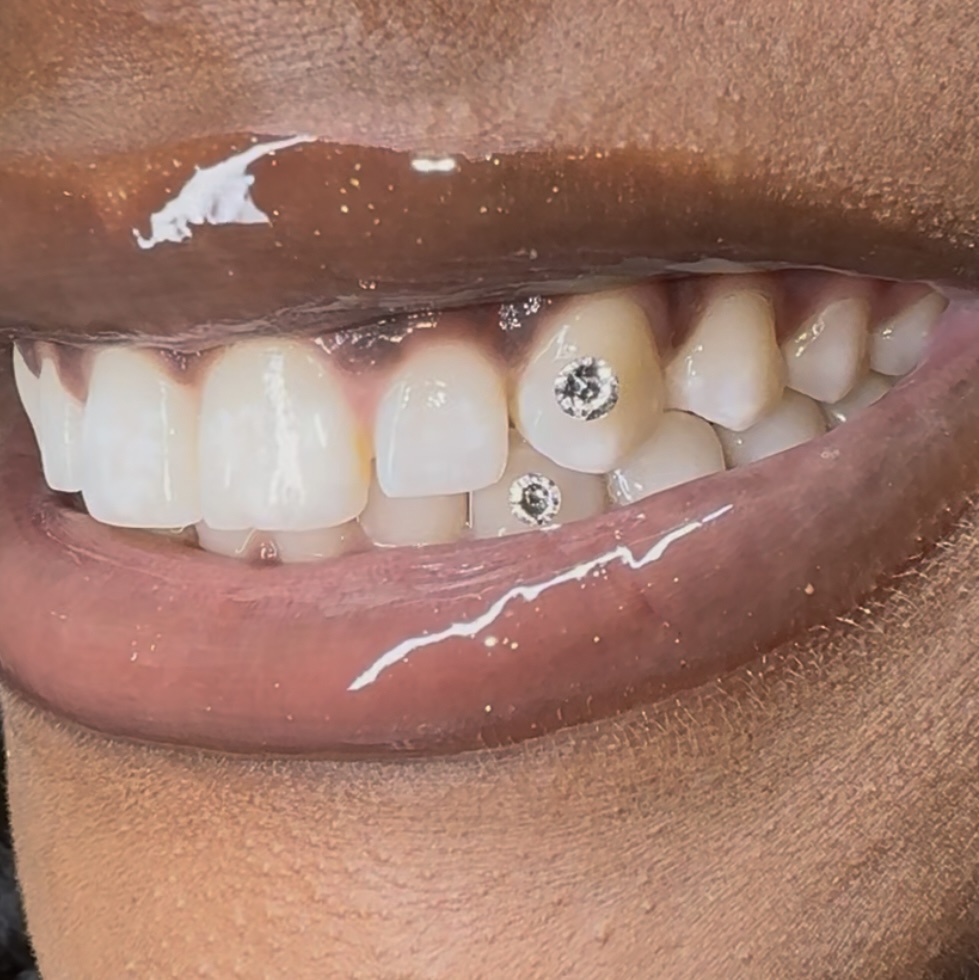 Tooth Gem / Adhesive Removal