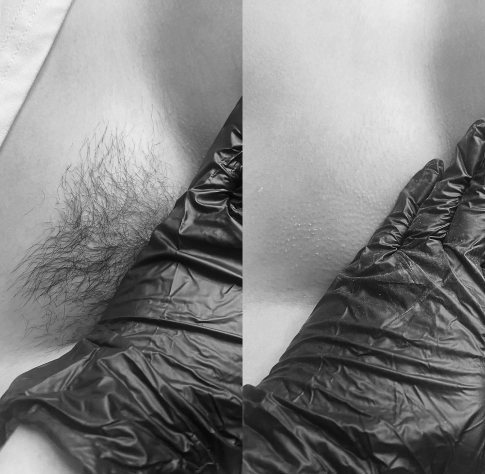Brazilian wax