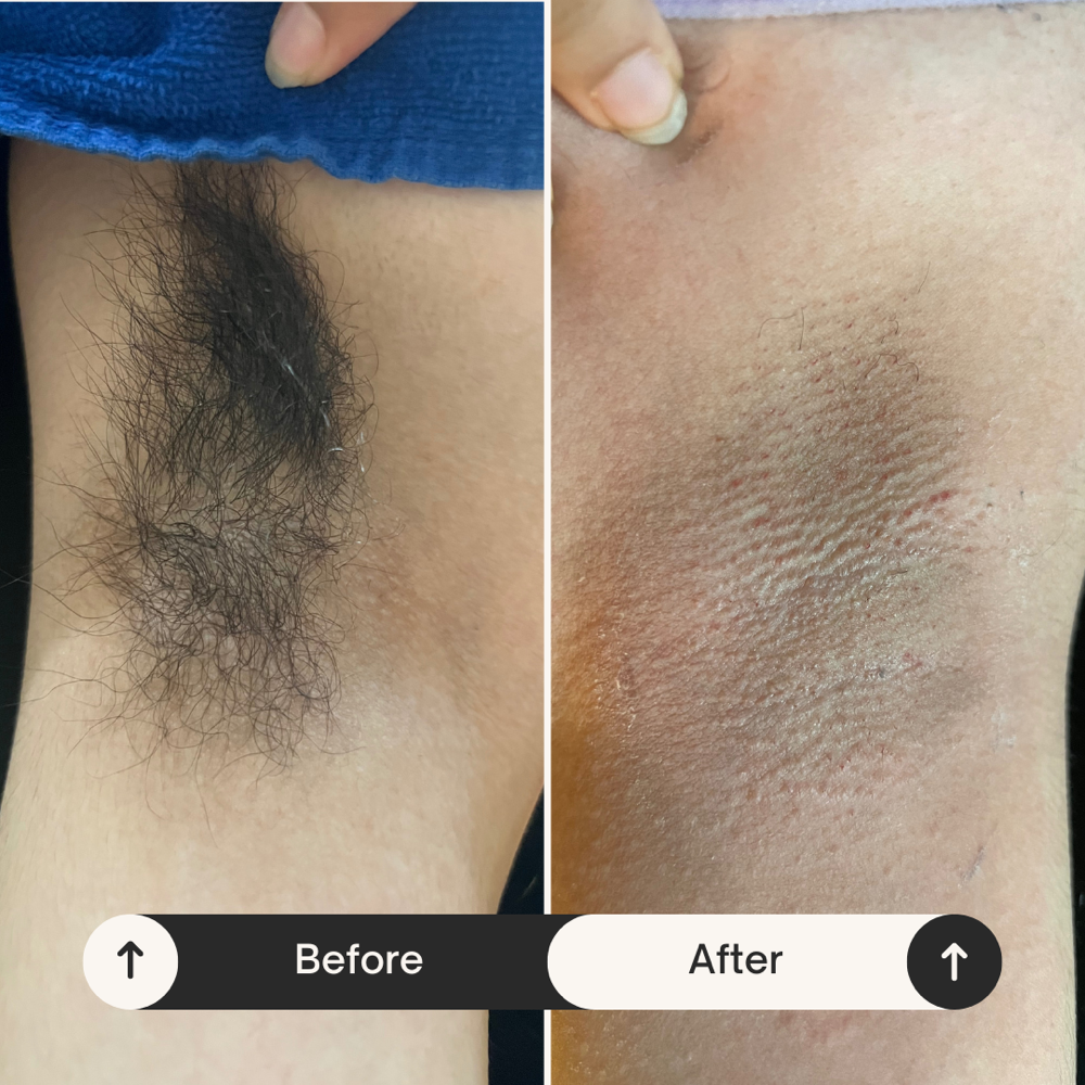 Under Arm Wax at Aesthetically You in Modesto, CA