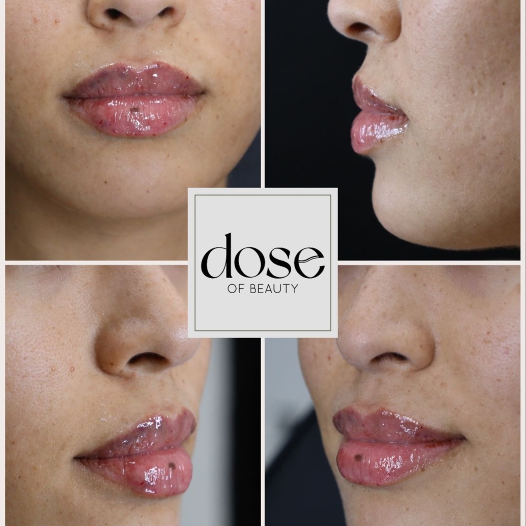 Lip Filler at DOSE OF BEAUTY in Mission, TX