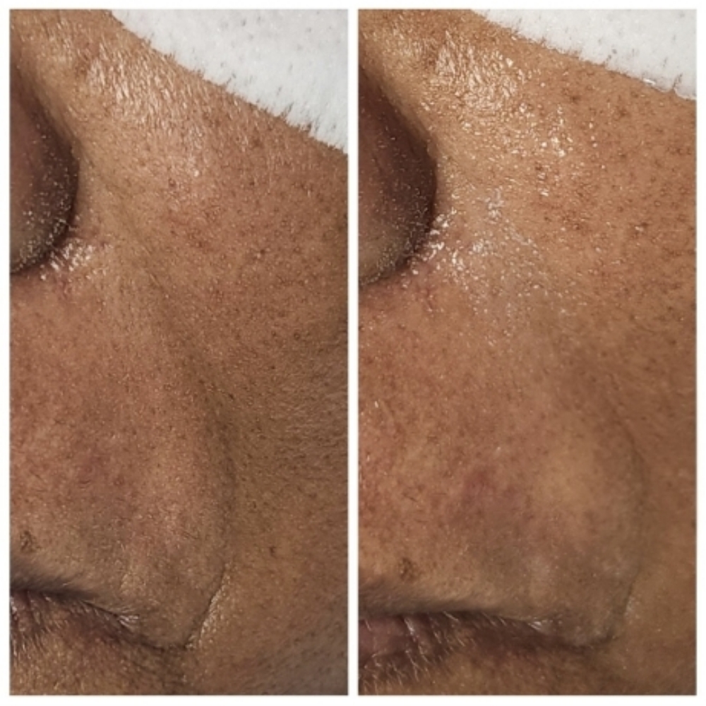 Hifu For Smile Line at Sun Skincare LLC in Scottsdale, AZ
