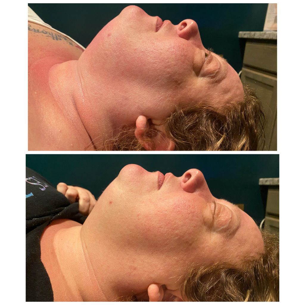 Neck Double Chin