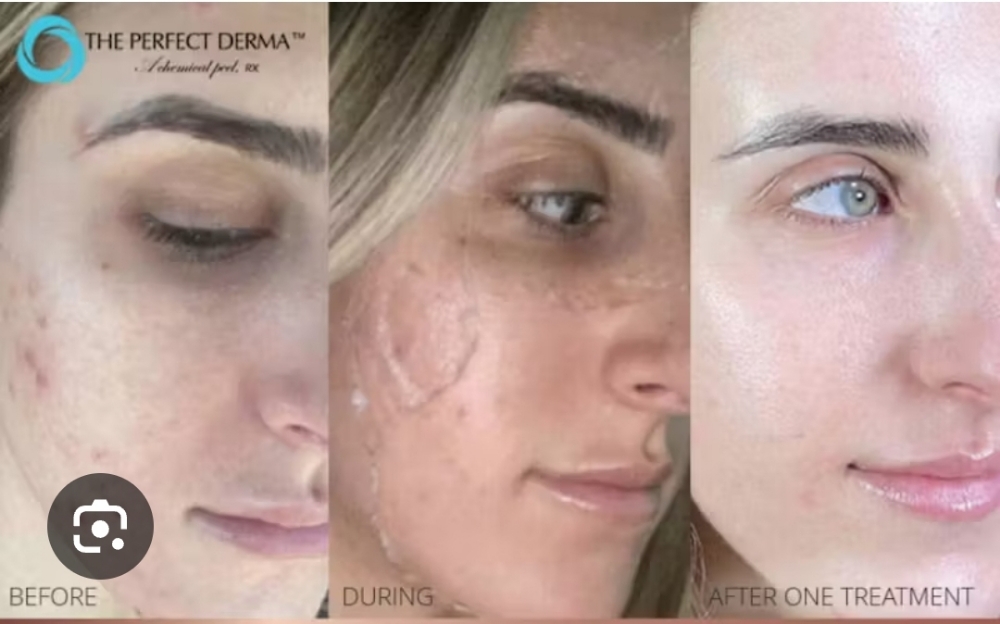 Perfect Derma Peel