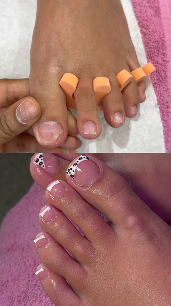 Toe Reconstruction at LuxBeautyLab in Kissimmee, FL