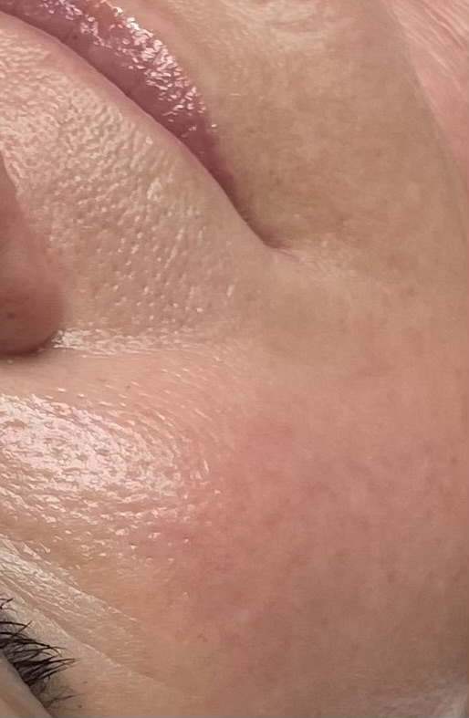 Luxury Dermaplane
