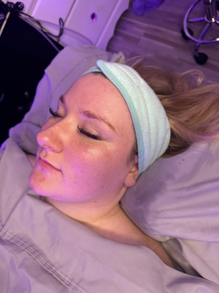 Microdermabrasion Facial