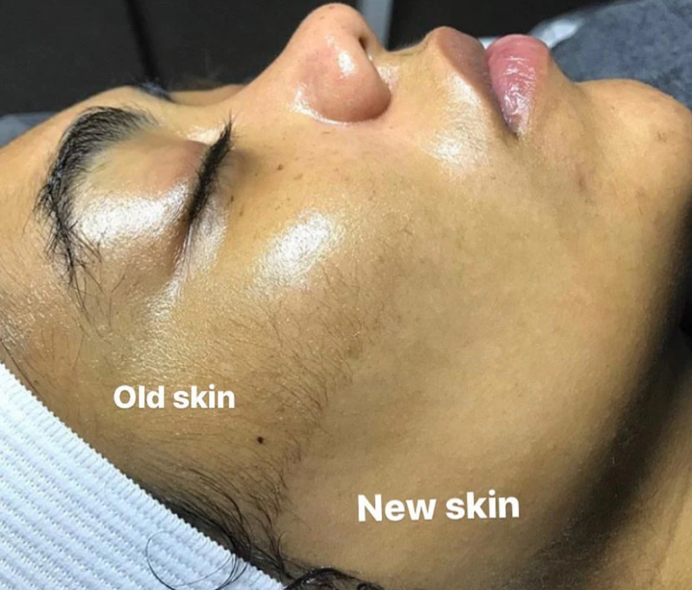 Dermaplane Facial