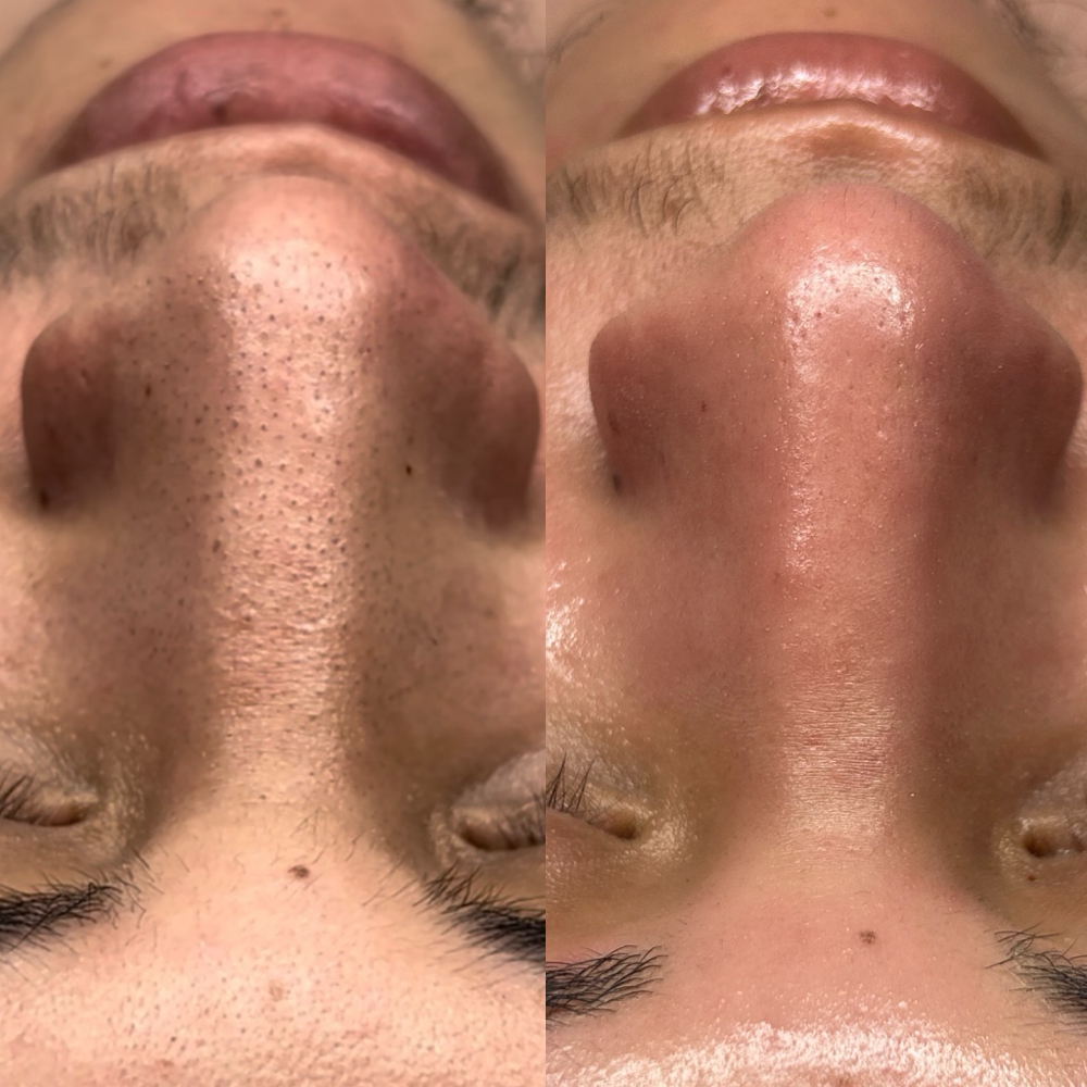 Acne Facial