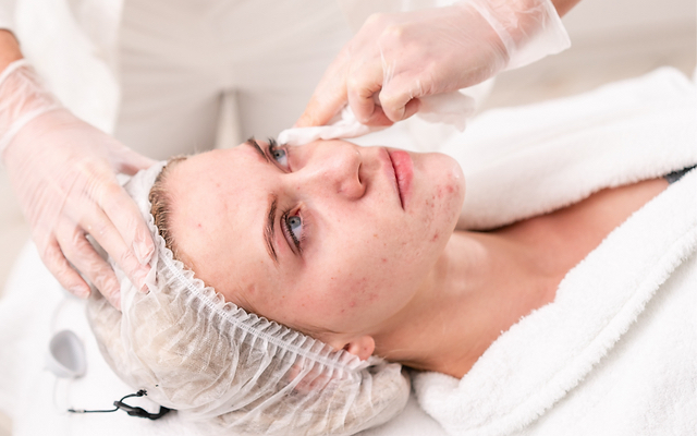 Acne Treatment Facial