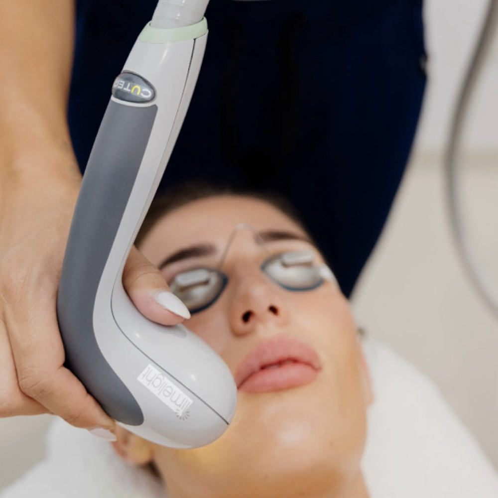 IPL (photofacial) at Lyfe Aesthetics & Medspa in Indianapolis, IN