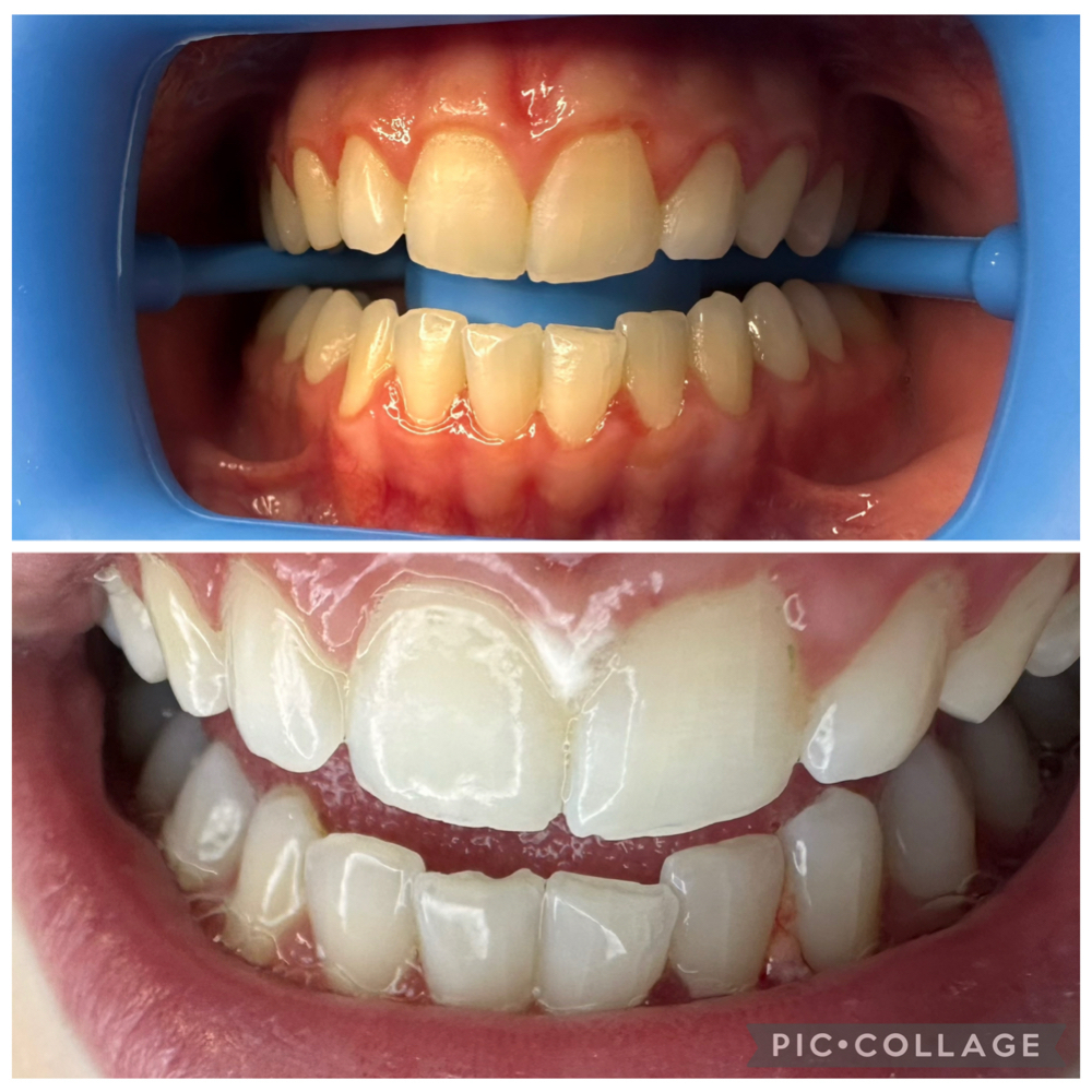 Teeth Whitening at House of Esthetics LLC in Casa Grande, AZ