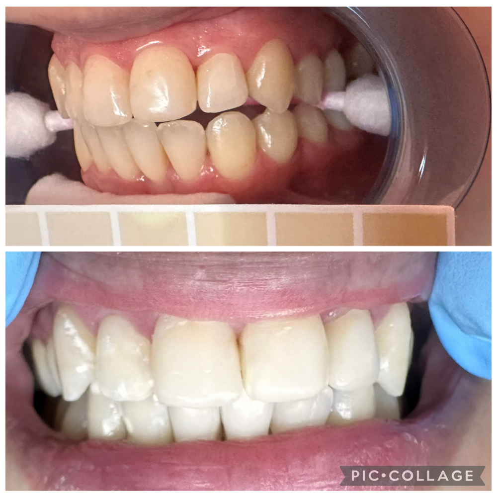 60 minute Teeth Whitening at House of Esthetics LLC in Casa Grande, AZ