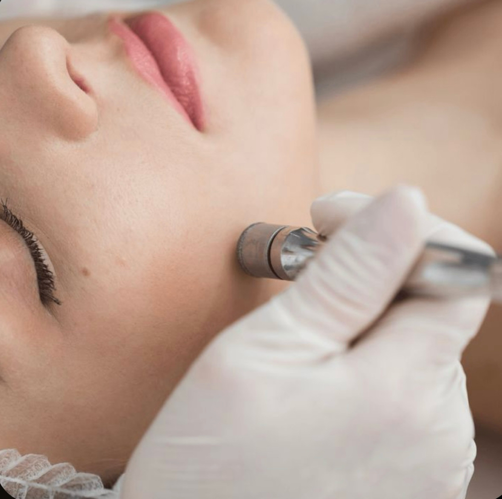 Microdermabrasion Facial