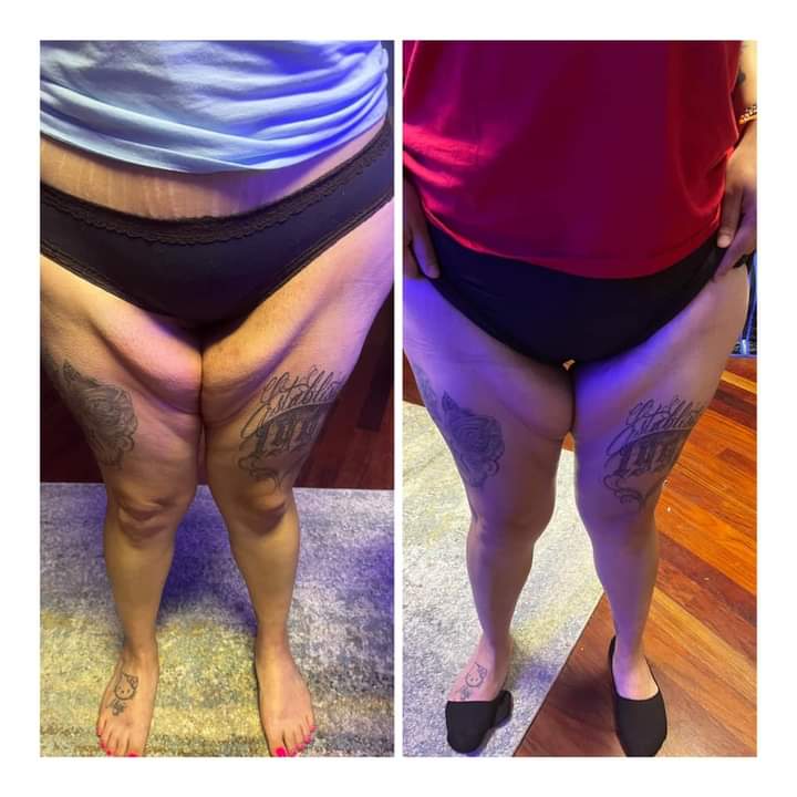 Inner thigh Reduction