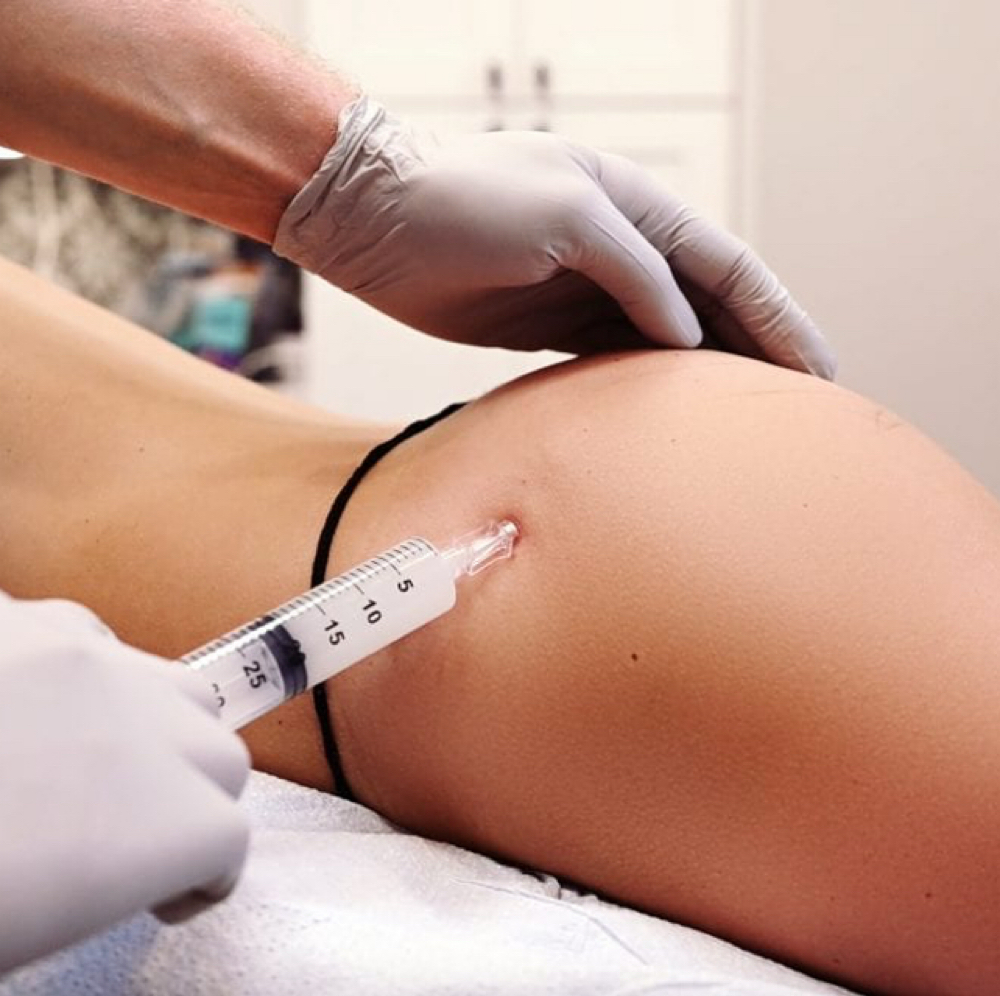 Liquid BBL at THRYV Aesthetics & Wellness in Lutherville-Timonium, MD