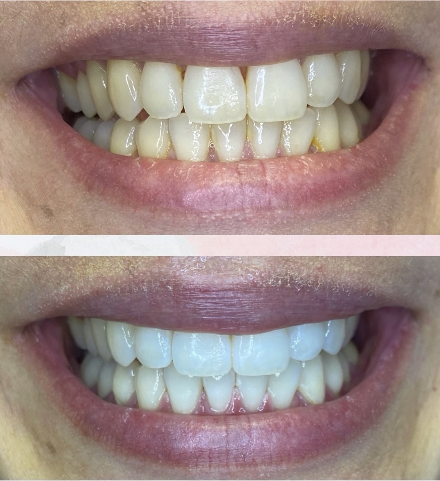 60 Min Teeth Whitening