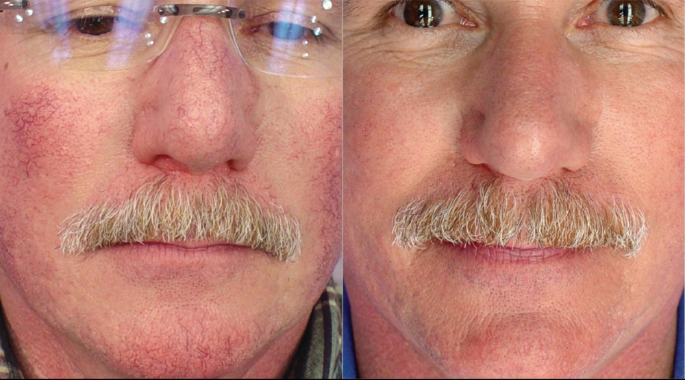 Vascular Treatments
