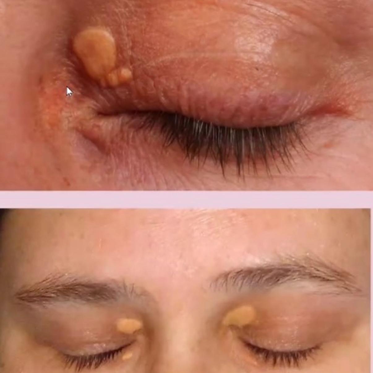 Cholesterol Deposits Removal at Serenity Aesthetics by Denise in St. John’s, FL