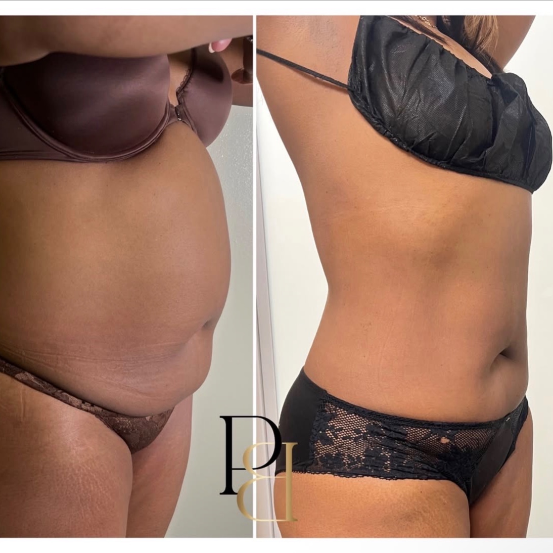 360 Fat Dissolving Injections at Pleasures of Beautee in Atlanta, GA