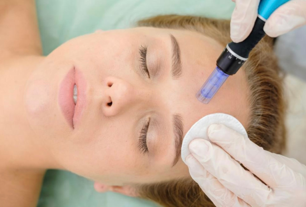 Microneedling