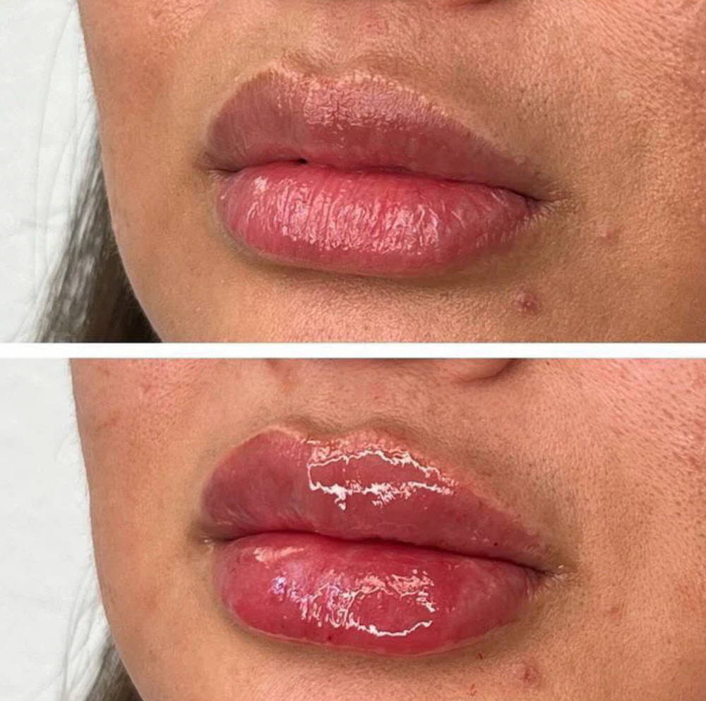 Micro Needle Lip Injection Filler