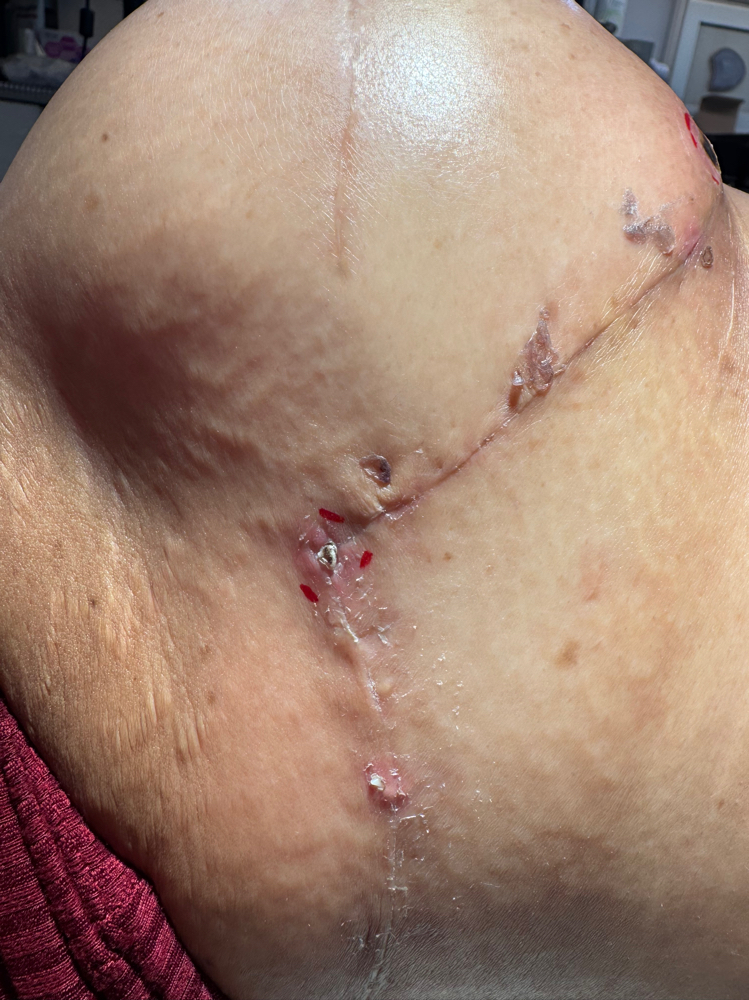 Post Mastectomy Lymphatic Drainage