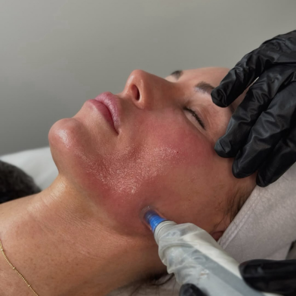 MiCRONEEDLING PaCKAGE at ILLUSIONS SALON & SPA in Warner Robins, GA