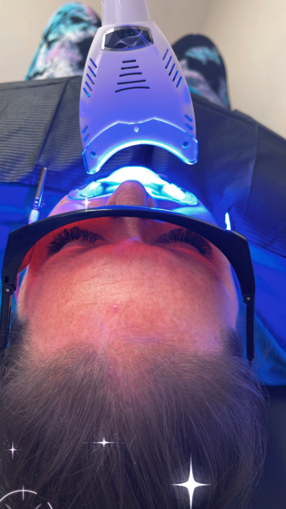 Teeth Whitening
