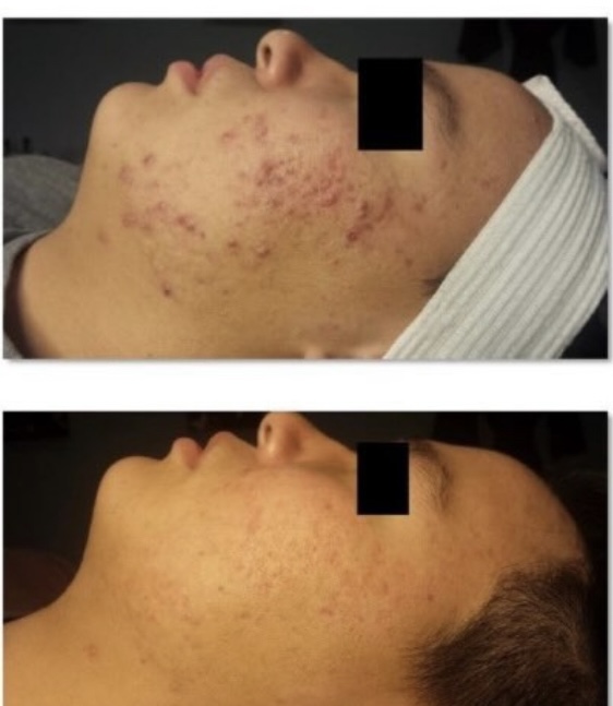 Celluma light therapy
