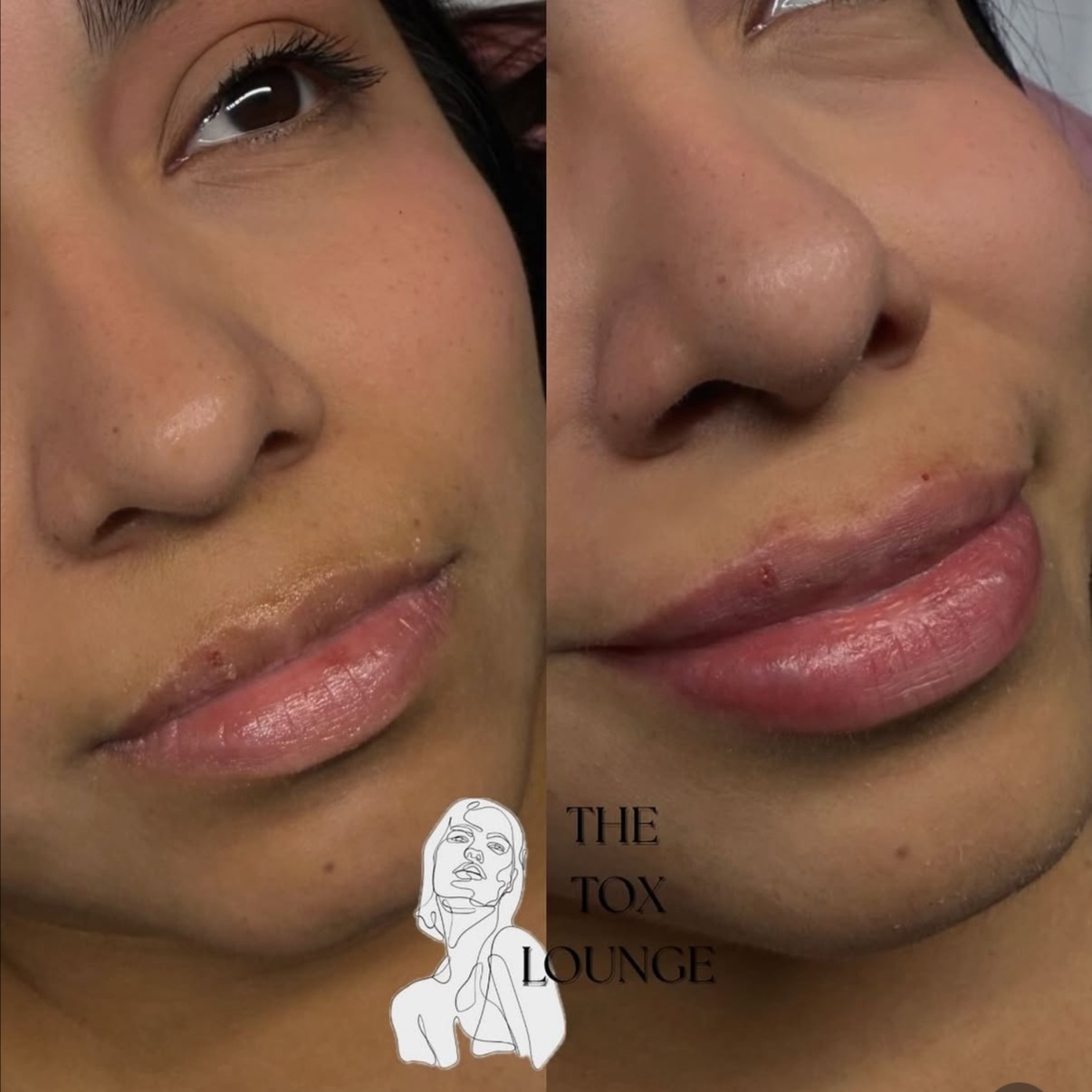 Lip Filler - Half Syringe at THE TOX LOUNGE in Terrell, TX