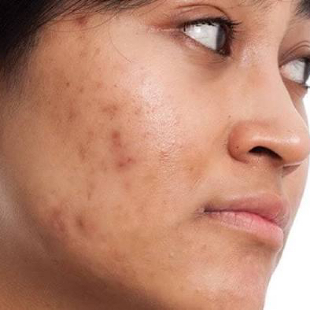 Acne Clearing Facial at Samantha  Woodruff in Lebanon, MO