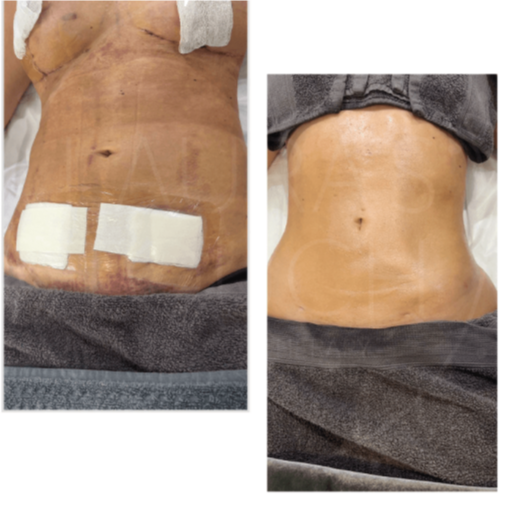 Taylor'd Post-Op Drain™